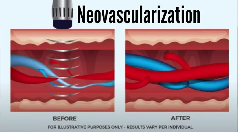 How Shockwave Therapy treats erectile dysfunction
